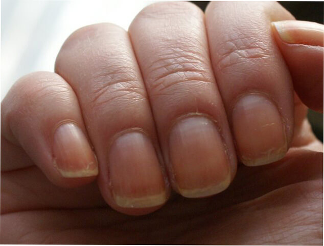 Как восстановить ногти после шеллака