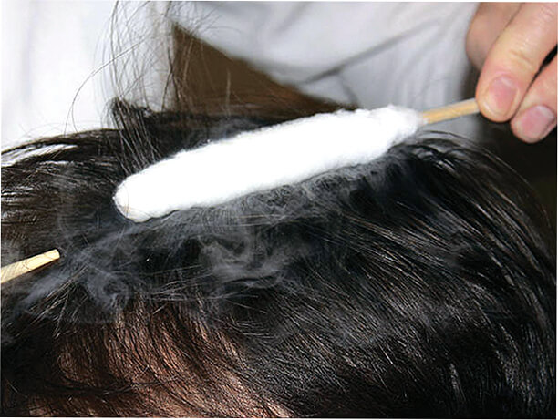 лечение волос жидким азотом
